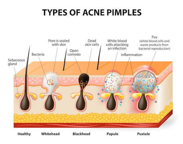 A diagram showing the different types of acne
