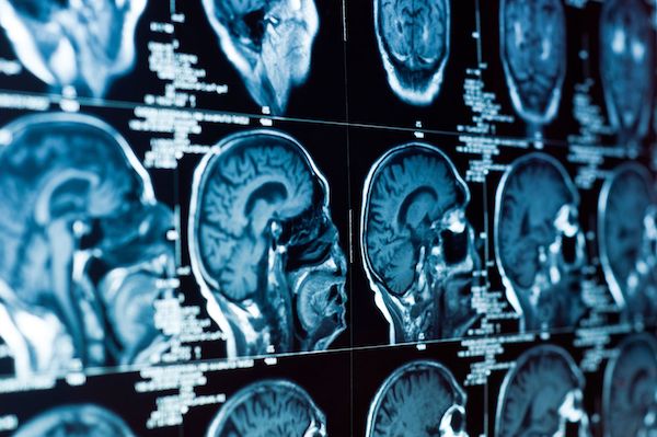 Brain cancer Brain scans showing cancer