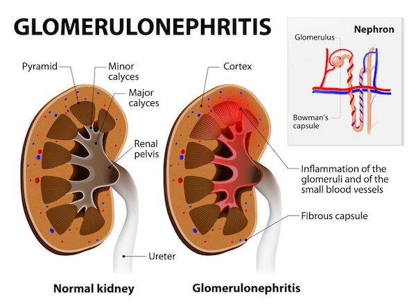 Glomerulonephritis A medical diagram of glomerulonephritis
