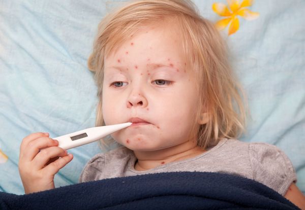 A child in bed with measles